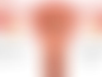 Endometrial Polyps