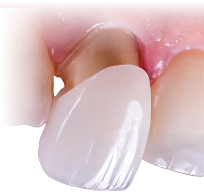 Ceramic dental crown being placed on a prepared tooth