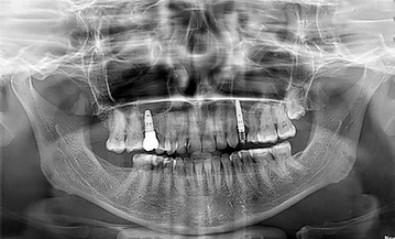 Implant