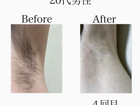 20代男性【ワキ】ビフォーアフター