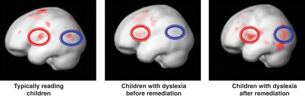 How Science Is Rewiring Dyslexic Brain >> Rewiring Dyslexic Brains Early Intervention And Remediation How Science Is Rewiring Dyslexic Brain >> Rewiring Dyslexic Brains Early Intervention And Remediation
