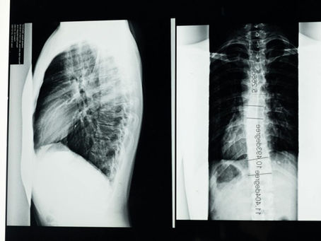 Small but Mighty Heroes: Children Battling Bone Cancer