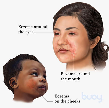 Medical Illustration - Facial Eczema Illustration