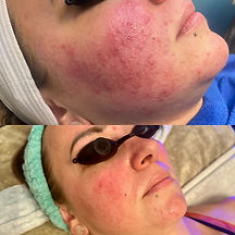 A before and after image of personalized Acne Boot Camp treatment