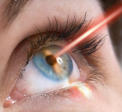 cirurgia a laser lasik prk para independencia dos oculos realizada pelo Dr. Luis Henrique Zucoloto Oftalmologista Sao Carlos