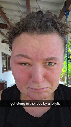 Day 2 - face already looked so much better!