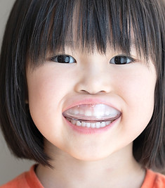 マウスピース治療をする女の子