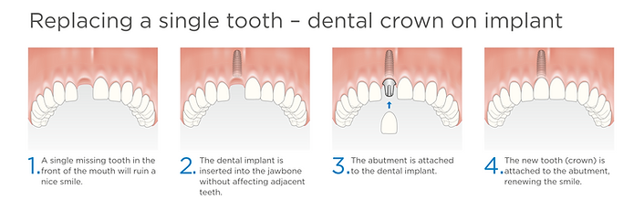Single tooth implant procedure.png