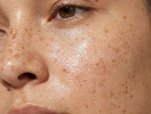 Alpha Arbutin for Hyperpigmentation