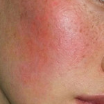 Woman With Freckles