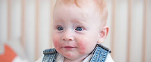 Mast cell activation syndrome; anaphylaxis; c-kit; hereditary α-tryptasemia; histamine; leukotriene C(4); mastocytosis; prostaglandin D(2); tryptase.