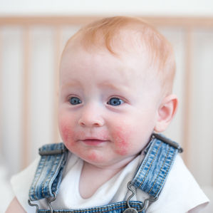 Baby mit empfindlicher Haut als Hinweis auf Allergien oder Infekte