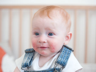 Smiling baby with eczema rash on cheeks