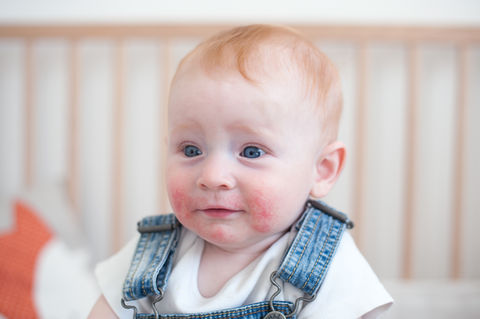 Baby mit empfindlicher Haut als Hinweis auf Allergien oder Infekte