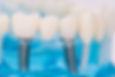Close up of dental model  with implantation