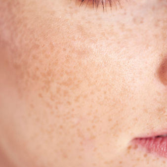 Moles, Freckles & Birthmarks: How to Spot The Difference