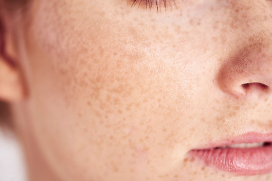 Freckles