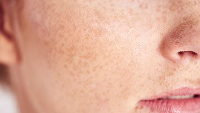 Hyper Pigmentation Removal