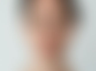 under eye bags and hollows