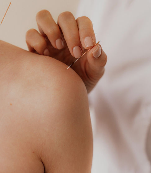 Acupuncture Therapy Session