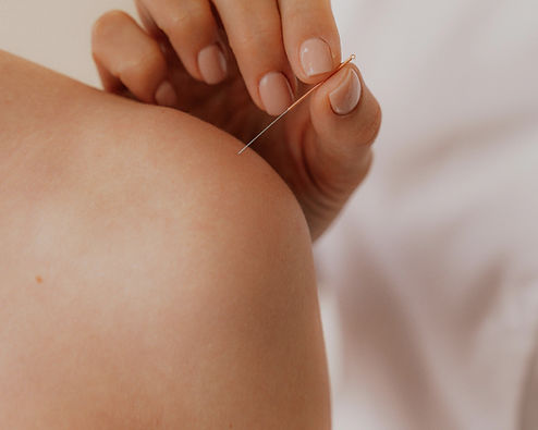 Acupunctuur Therapie Sessie