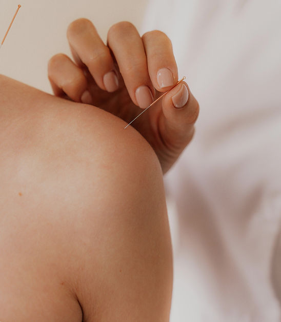 Acupuncture Therapy Session