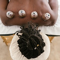 Cupping Therapy Session