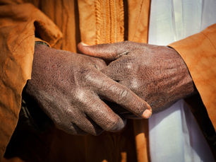 Atopic Dermatitis