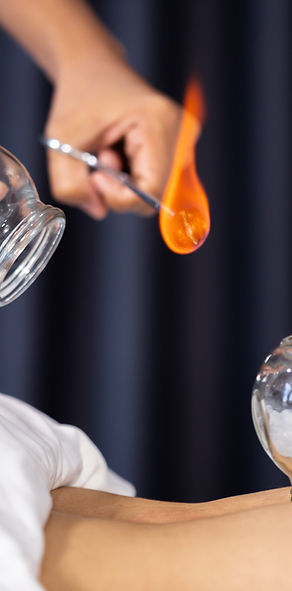 Cupping Therapy administration showing glass cups applied to a naked back, using a flame source to create a vacum in the cup before application (known as fire cupping). Links to cupping therapy service description for  Lotus Palm Health & Wellness.