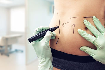 Body Contouring Marks