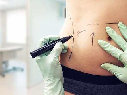 Abdominoplasty