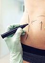 Body Contouring Marks