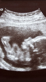 20-week-pregnancy-scan