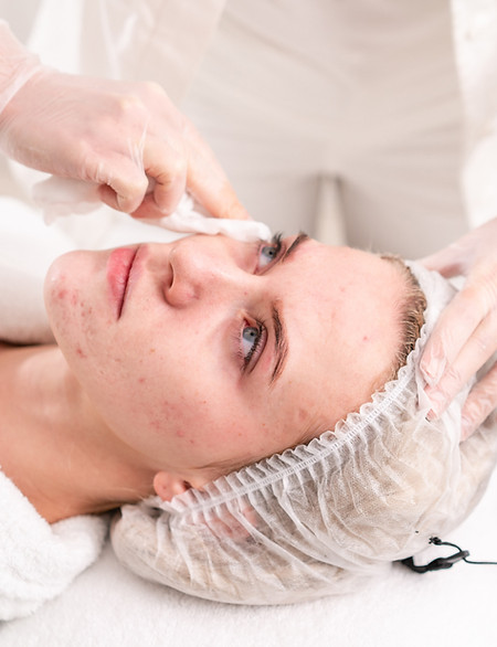 Traitement de l'acné