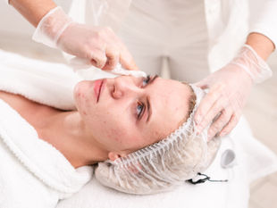 Clearing the Canvas: The Ultimate Guide to Laser Acne Treatment