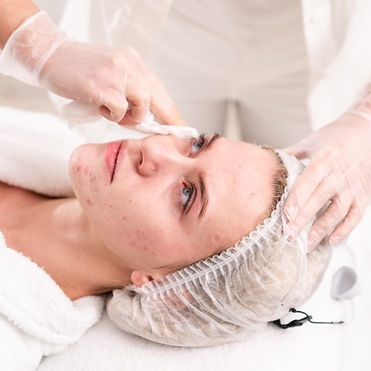 Acne Treatment