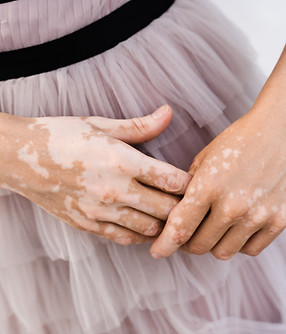Hands With Vitiligo