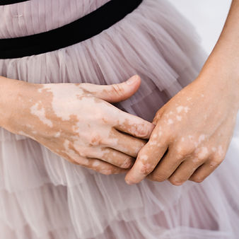 Hender med vitiligo