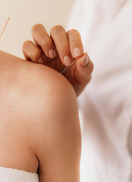 Shoulder Acupuncture Treatment