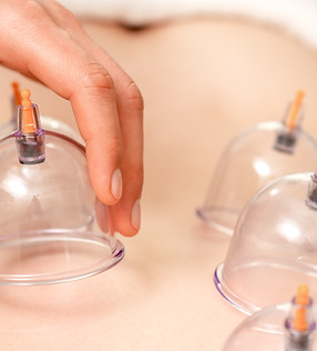 Cupping