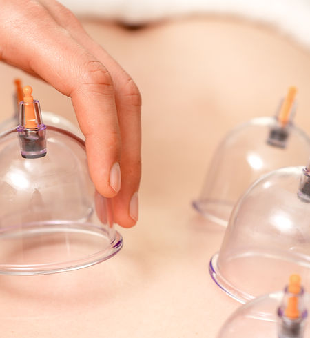 Schröpfmassage mit Glaskugeln oder Schröpfgläsern auf dem Rücken – zur Förderung der Durchblutung und Entspannung.