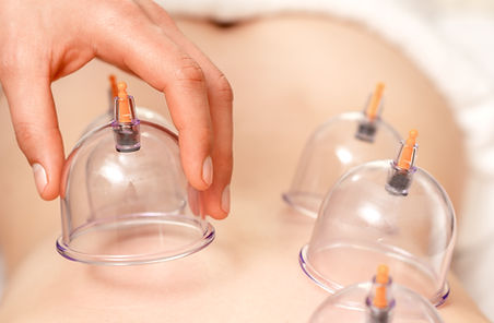 Cupping