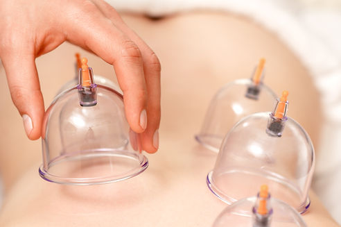 Cupping therapy in Abilene — clear suction cups placed on the back to boost circulation and relieve tightness.