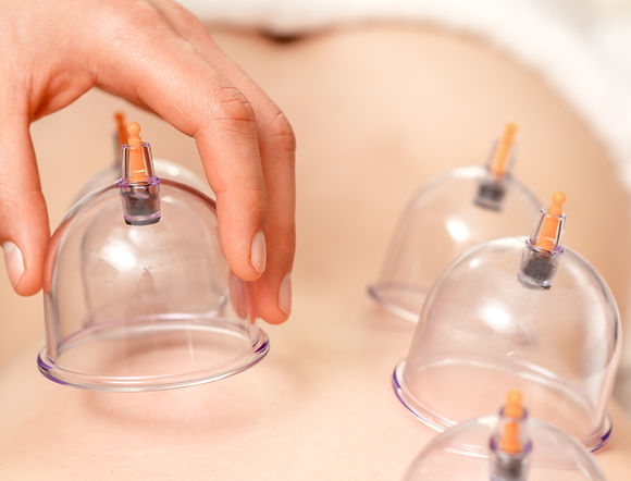 Cupping