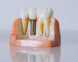 Root Canal