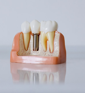 Modello di impianto dentale