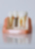 Modelo de implante dental