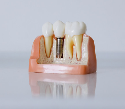 Dental Implant
