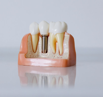 Root Canal