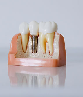 Diş İmplantı Modeli